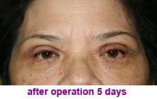 plastic-surgery-blepharoplasty